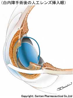 白内障手術後の人工レンズ挿入眼