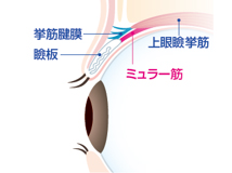 眼瞼下垂